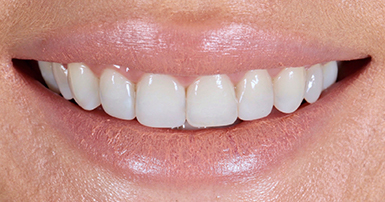 After - Ringway Dental