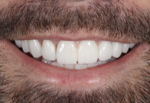 Dental Implants - After