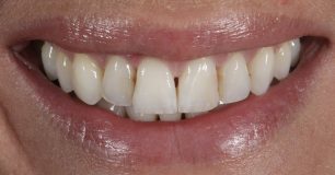 Before - Ringway Dental