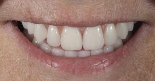 After - Ringway Dental