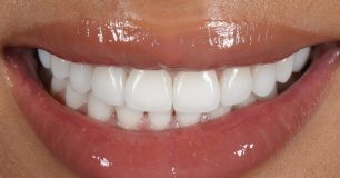 After - Ringway Dental