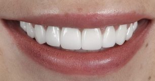 After - Ringway Dental