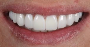 After - Ringway Dental