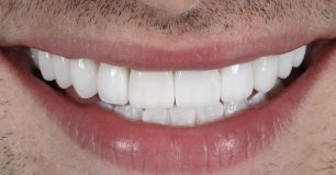 After - Ringway Dental