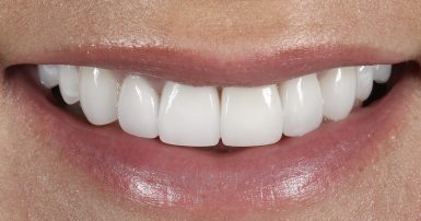 After - Ringway Dental