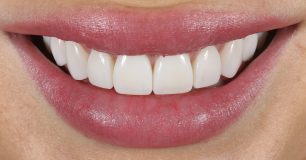 After - Ringway Dental